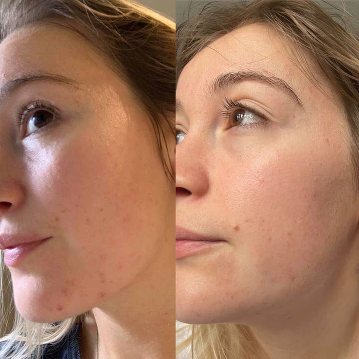 Douvall's - Vente Concentré/sérum pour le visage - Sérum de réadaptation contre l'acné 30 ml6