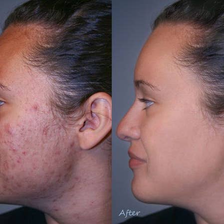 Nancy Natural Beauty Skincare - Wholesale Gezichtsolie - Natuurlijke acne en hyperpigmentatieolie (Tamanu + Acai-olie)2