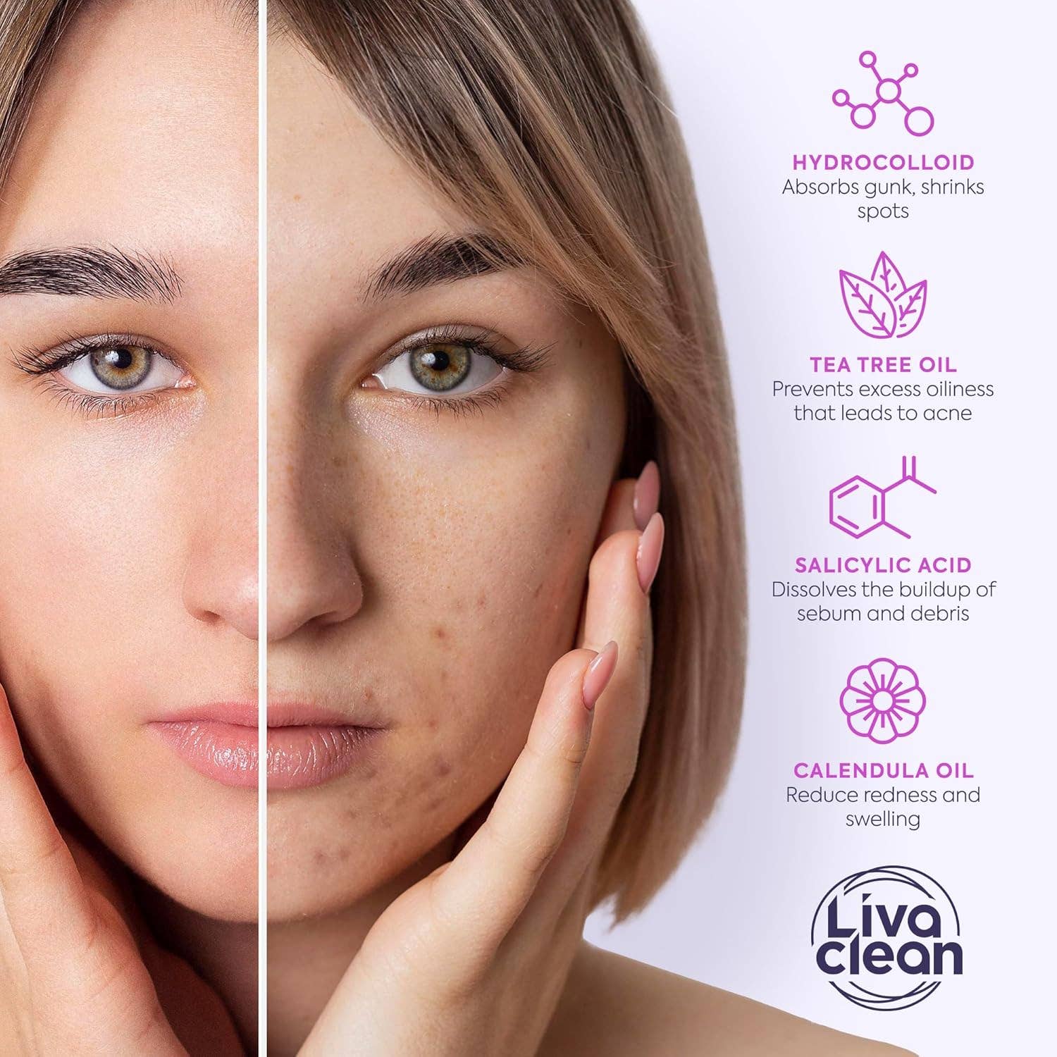 Livaclean - Wholesale Acne/Hydrocolloid Patch - 330CT Pimple Patches Hydrocolloid Patch Spot Treatment with Salicylic Acid, Tea Tree Oil & Calendula Oil - 4 Sizes4