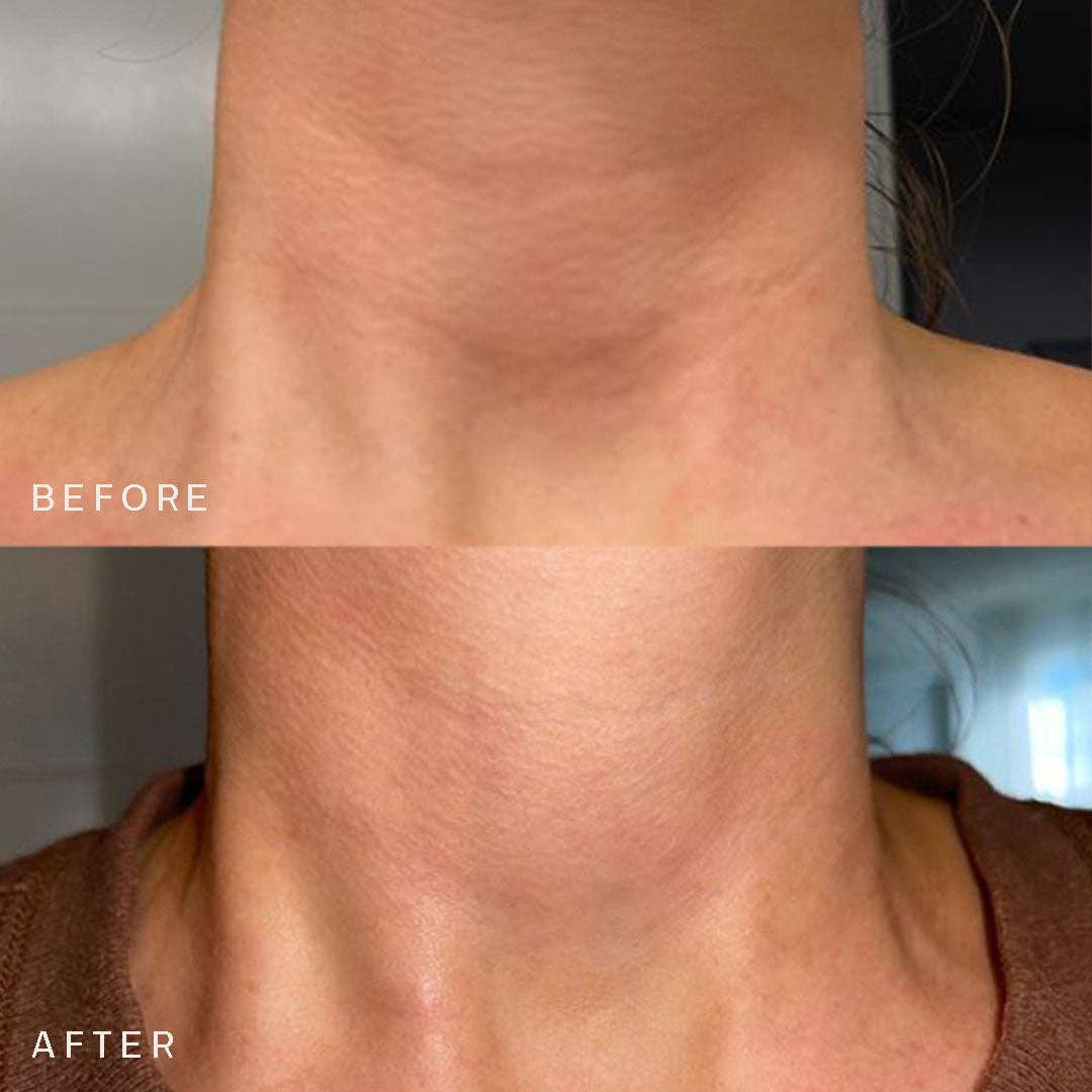 Dermaclara Beauty – Engroshandel Ansigtsmaske – BACKBAR: Pakke med 10 Neck Occlusion Patches™1