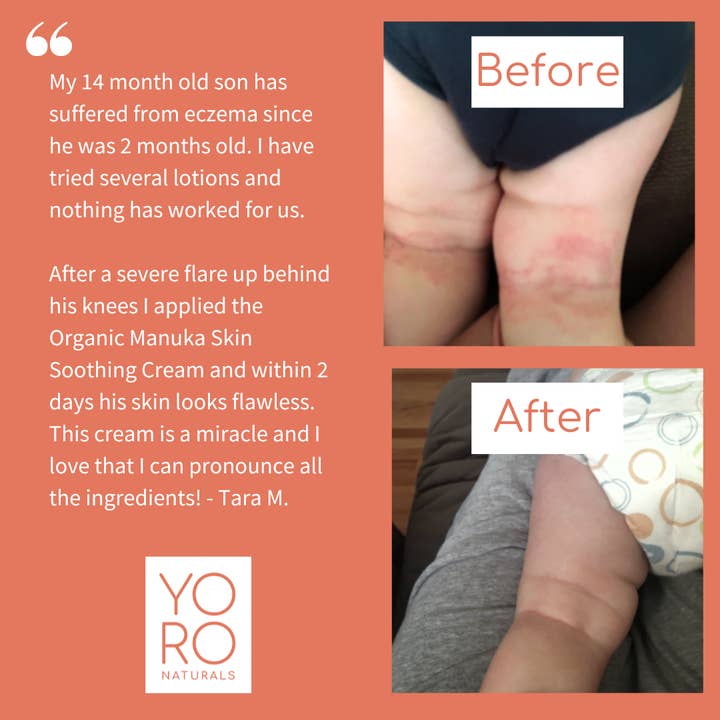 YoRo Naturals - Wholesale Healing Salve/Balm/Cream - Original Organic Manuka Skin Soothing Cream - Per Unit
