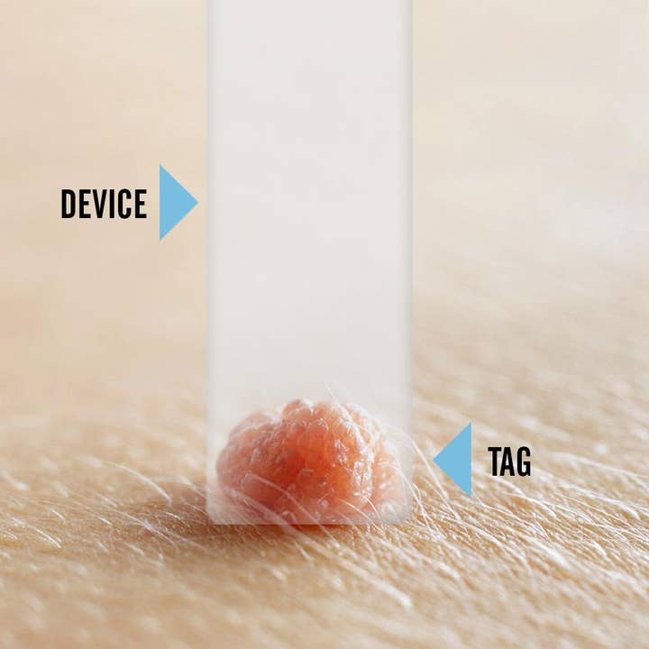 My Wholesale Warehouse – wholesale Electronic skincare device – Tagcure PLUS - Skin Tag Removal Device2