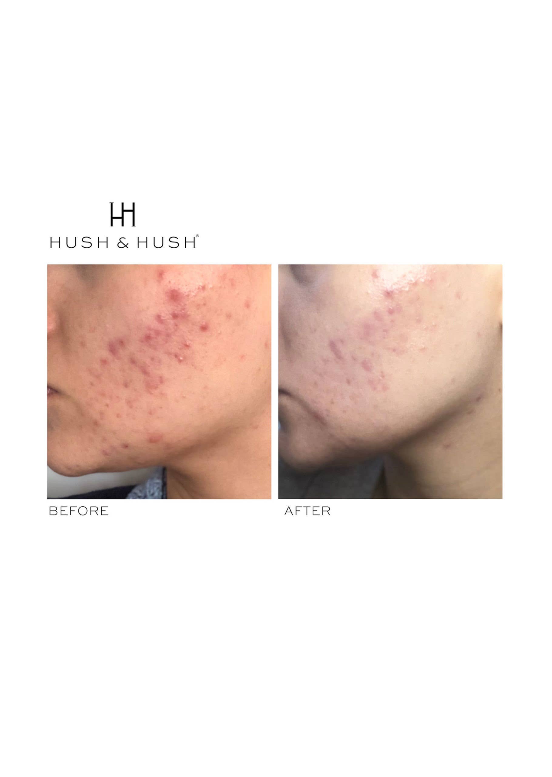 Hush & Hush - Wholesale Oral Supplement/Vitamin - Natural Supplement for Breakouts5