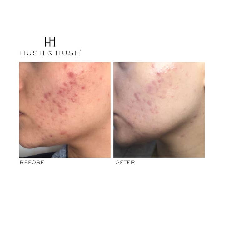 Hush & Hush - Wholesale Oral Supplement/Vitamin - Natural Supplement for Breakouts5