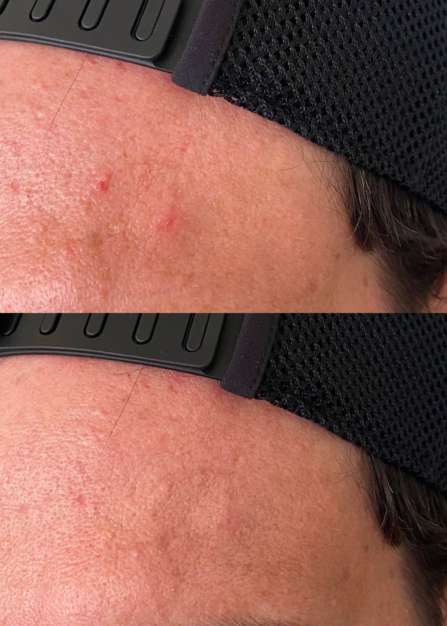 August & Monroe, Inc - Wholesale Acne/Hydrocolloid Patch - 3-IN-1 BLEMISH CAMOUFLAGE7