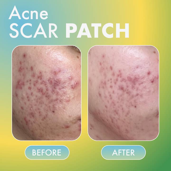Fazit – wholesale Akne-/hydrokolloidplåster – Fazit Acne Scar Patches för ansikte, bikini och kropp