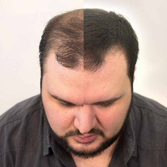 My Wholesale Warehouse – wholesale Hair thinning/loss treatment – Volumon Hair Building Fibres - COTTON 28g - For Men & Women