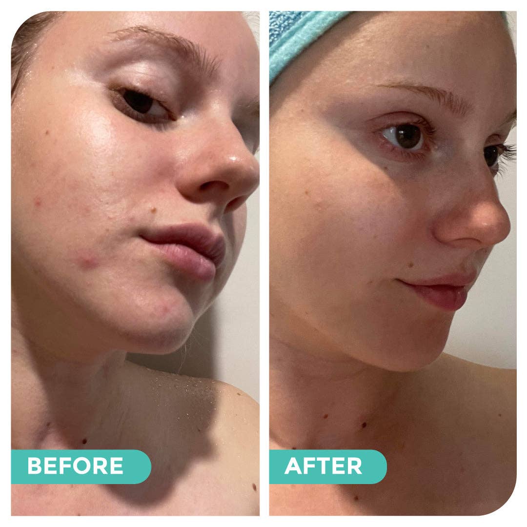 Hemp Co Australia - Wholesale Facial Care Set/Kit - Acne skincare bundle22