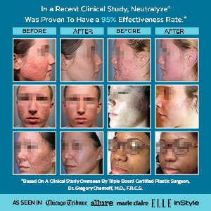 Neutralyze - Wholesale Facial Cleanser - Neutralyze® Acne Face Wash - Sample
