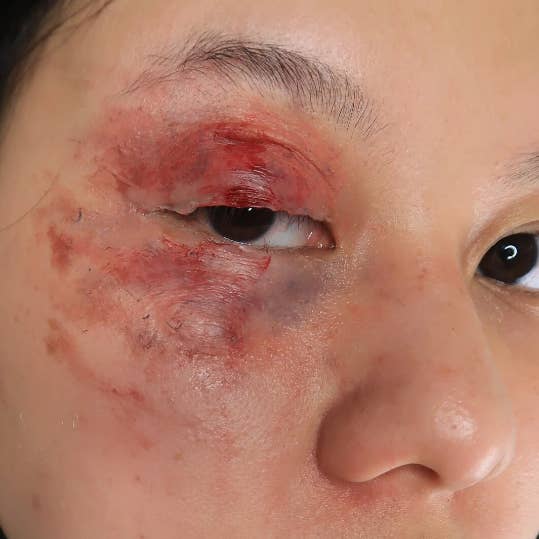 Right Swollen bruised Eye / Fight scene / boxing / Zombie / for wholesale by DESIRED FX