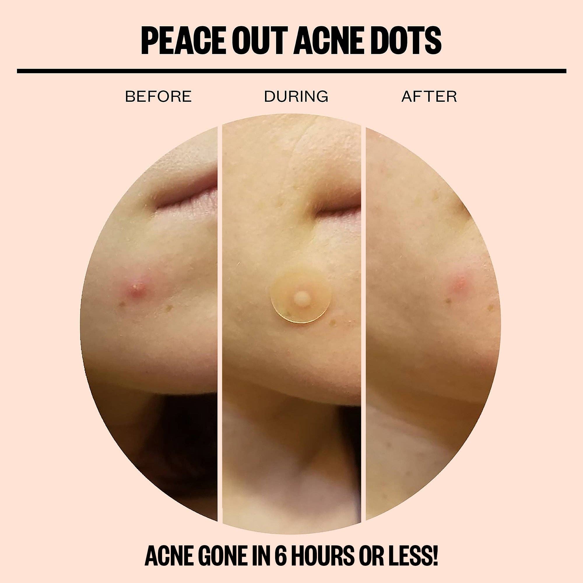 Peace Out Skincare - Wholesale Acne/Hydrocolloid Patch - Acne Dots - 10 Pack2