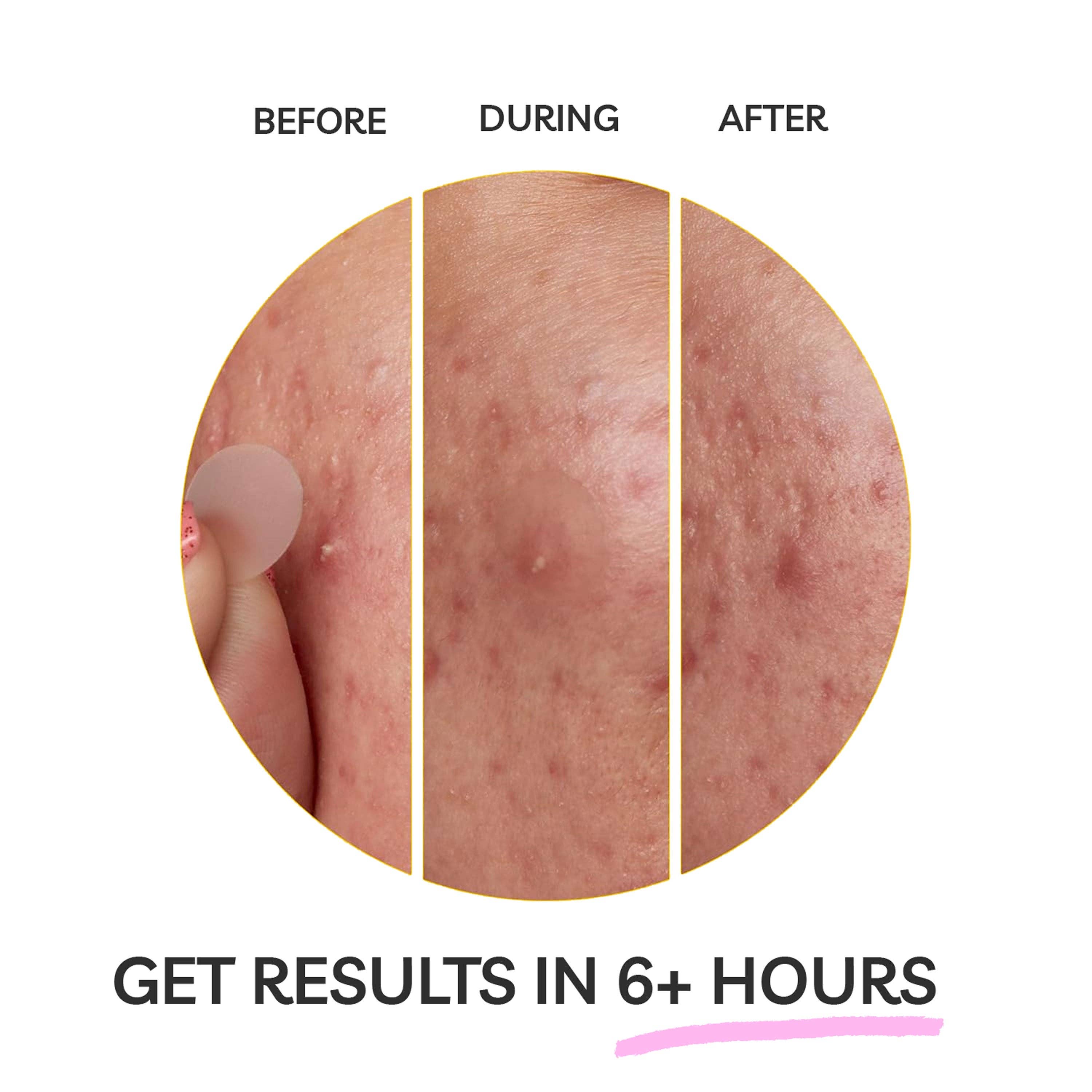 My Wholesale Warehouse - Vente Patch contre l'acné/hydrocolloïde - Patchs Hydrocolloïdes Anti-Imperfections Clear Molecule - Biseautés 12mm - Pack de 308