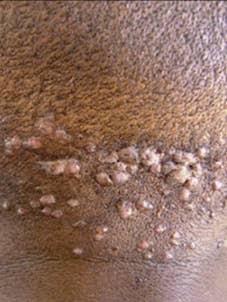 Natürlicher Bump Stopper Creme und Seife für den Großhandel von Nancy Natural Beauty Skincare