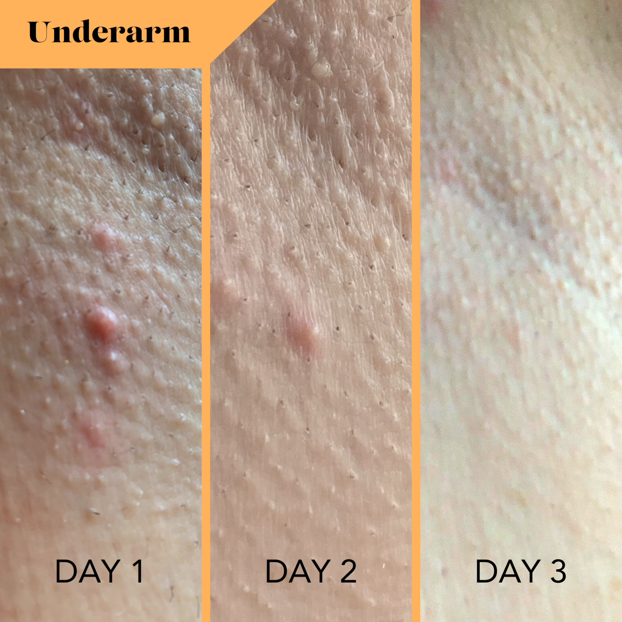 Sweetspot Labs - Wholesale Acne/Hydrocolloid Patch - Bikini & Body Bump Eraser - Ingrown Hair Treatment4