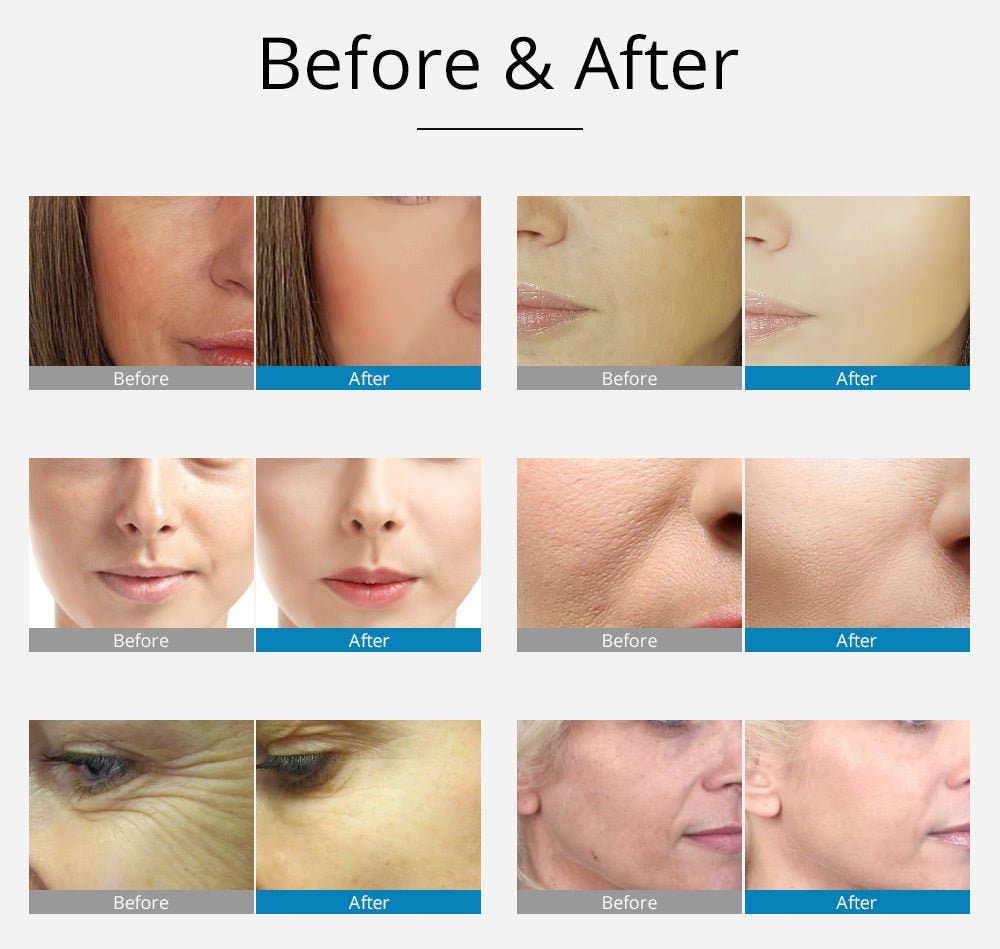 Cavitation Machines - Wholesale Electronic Skincare Device - Shape Tactics 2-in-1 RF EMS Mesotherapy Skin Rejuvenation System13