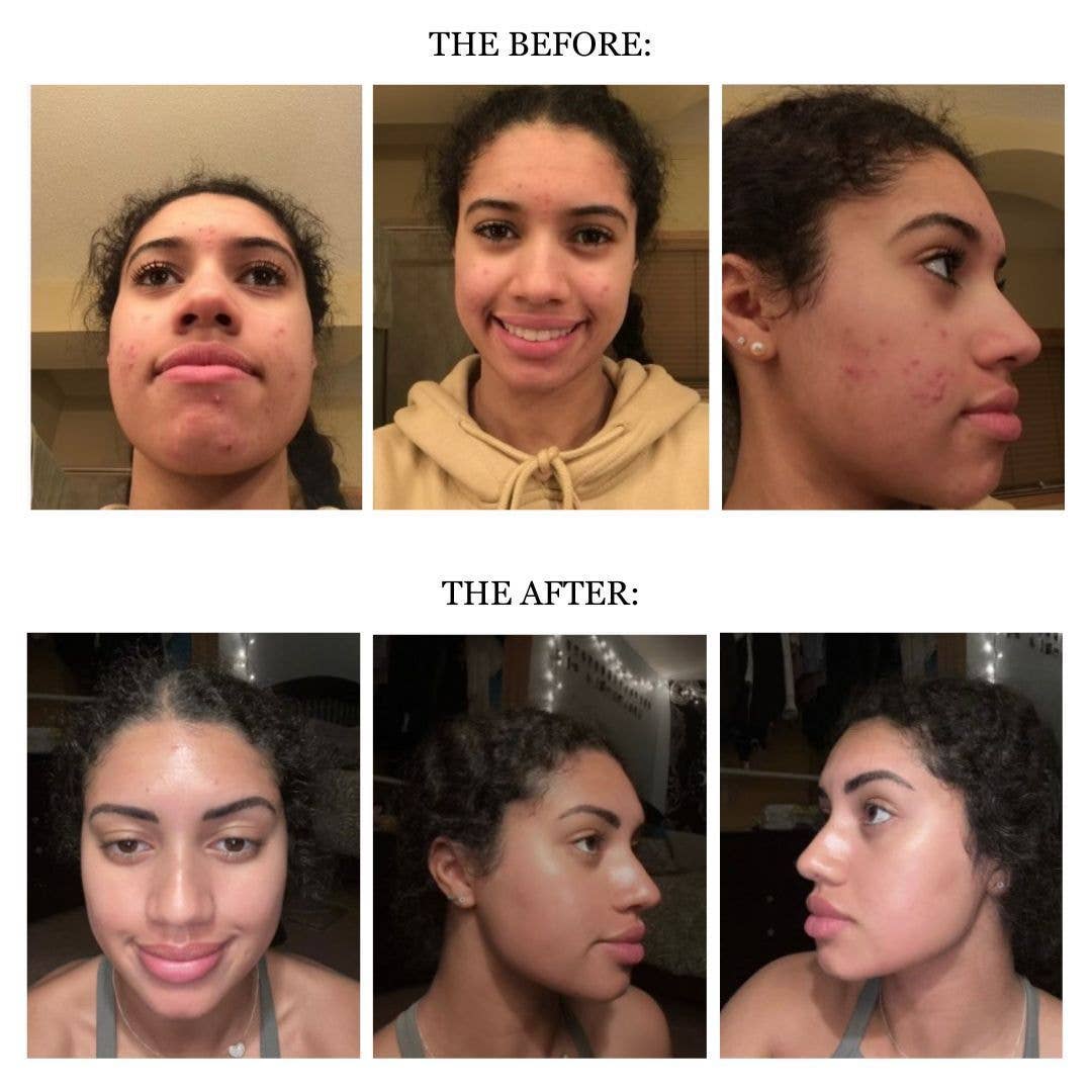 ATZEN Skin Care - Wholesale Acne/Hydrocolloid Patch - PURIFY Breakout Remedy (acne spot treatment)1