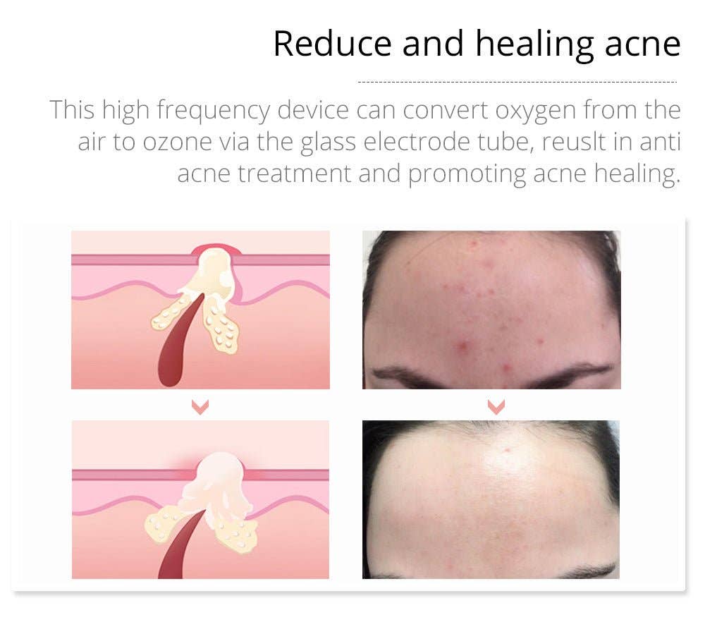 Cavitation Machines - Wholesale Electronic Skincare Device - Shape Tactics Violet 7-Electrode High-Frequency Facial System17