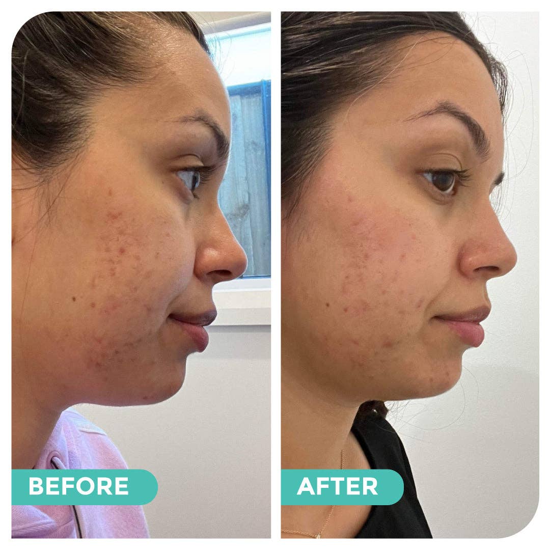 Hemp Co Australia - Wholesale Facial Care Set/Kit - Acne skincare bundle8