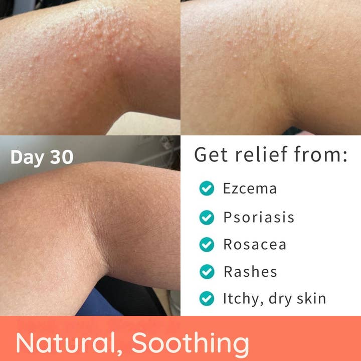 YoRo Naturals - Wholesale Hand & Body Lotion - Natural Manuka Honey Balm for Eczema, Sensitive and Dry Skin1