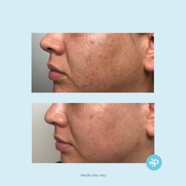 Perfect Image - Wholesale Facial Peel - Revitaboost Peel Pads - Level 24