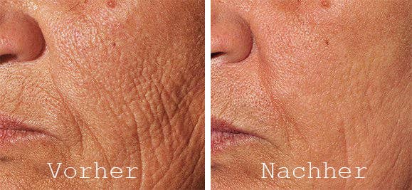 Candy Cush - Wholesale Face/Beauty Roller - dermaroller 0.5 mm7