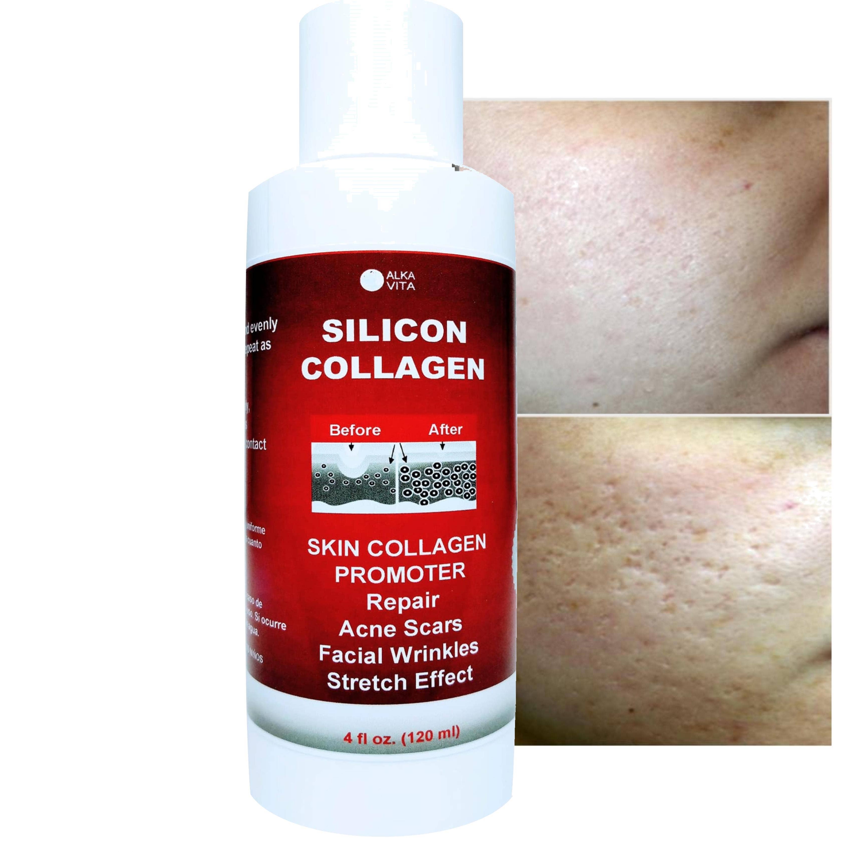 AlkaVita – Adesivo de acne/hidrocolóide por atacado – Cicatrizes de acne Silicon Gel Pele Colágeno Promotor Resurfacing1