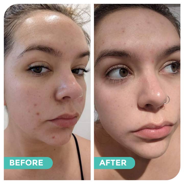 Hemp Co Australia - Wholesale Facial Care Set/Kit - Acne skincare bundle23