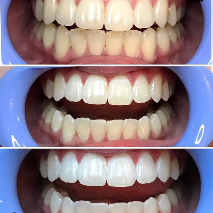 Beautiful Bright Smile - Wholesale Teeth Whitener - PRO SERIES - POWER PRO TEETH WHITENING KIT