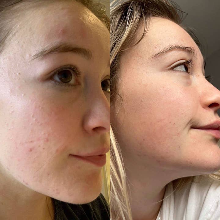 Douvall's - Vente Concentré/sérum pour le visage - Sérum de réadaptation contre l'acné 30 ml7