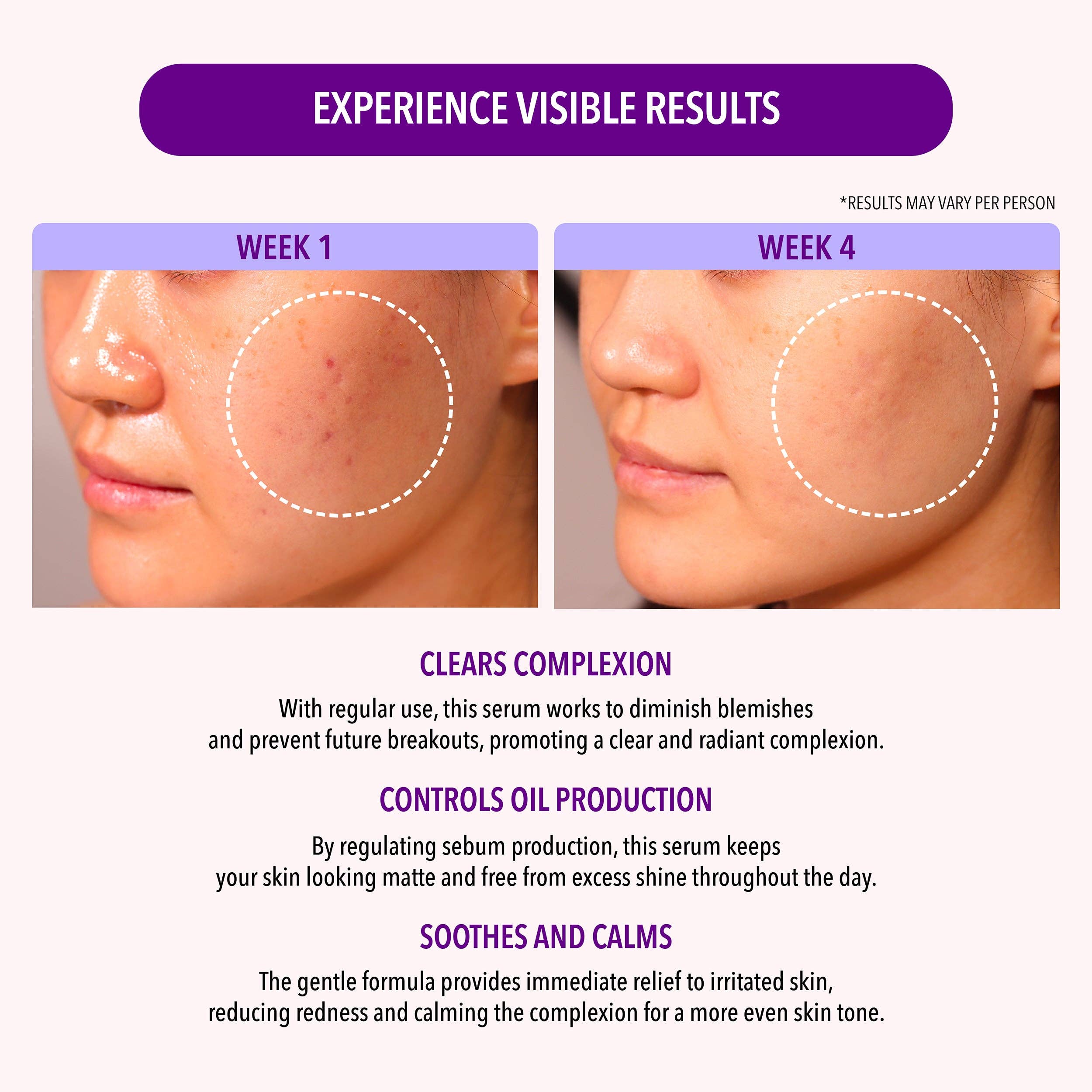 Moira Cosmetics - Wholesale Facial Serum/Concentrate - 10% Niacinamide & 1.9% Salicylic Acid Oil Control Serum3