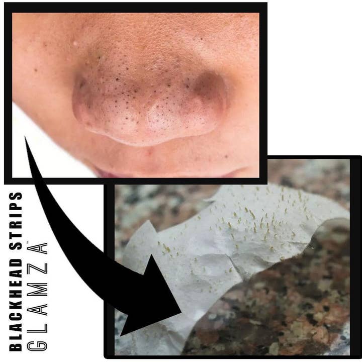My Wholesale Warehouse - Venta al por mayor Parches para el acné/hidrocoloides - Tiras nasales de limpieza profunda Glamza para espinillas