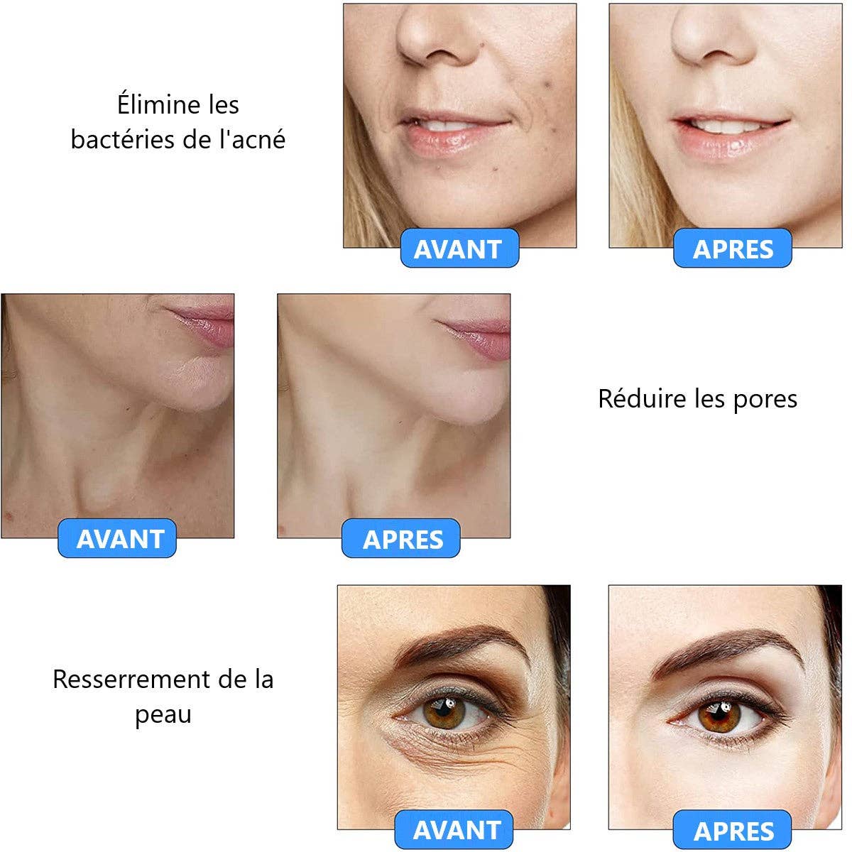 PALOMA BEAUTIES - Wholesale Electronic Skincare Device - ANTI IMPERFECTION PEN3