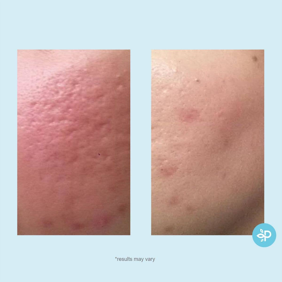 Perfect Image - Wholesale Facial Peel - Lactic 50% Gel Peel - Level 23