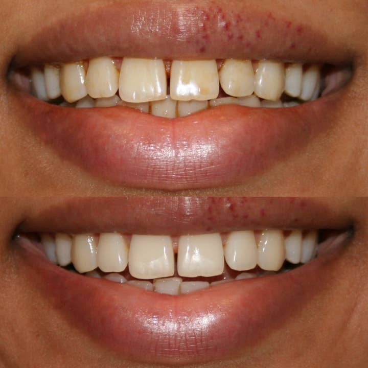 Smile Science Harley Street - Vente Produit de blanchiment des dents - Kit de blanchiment des dents Smile Science7