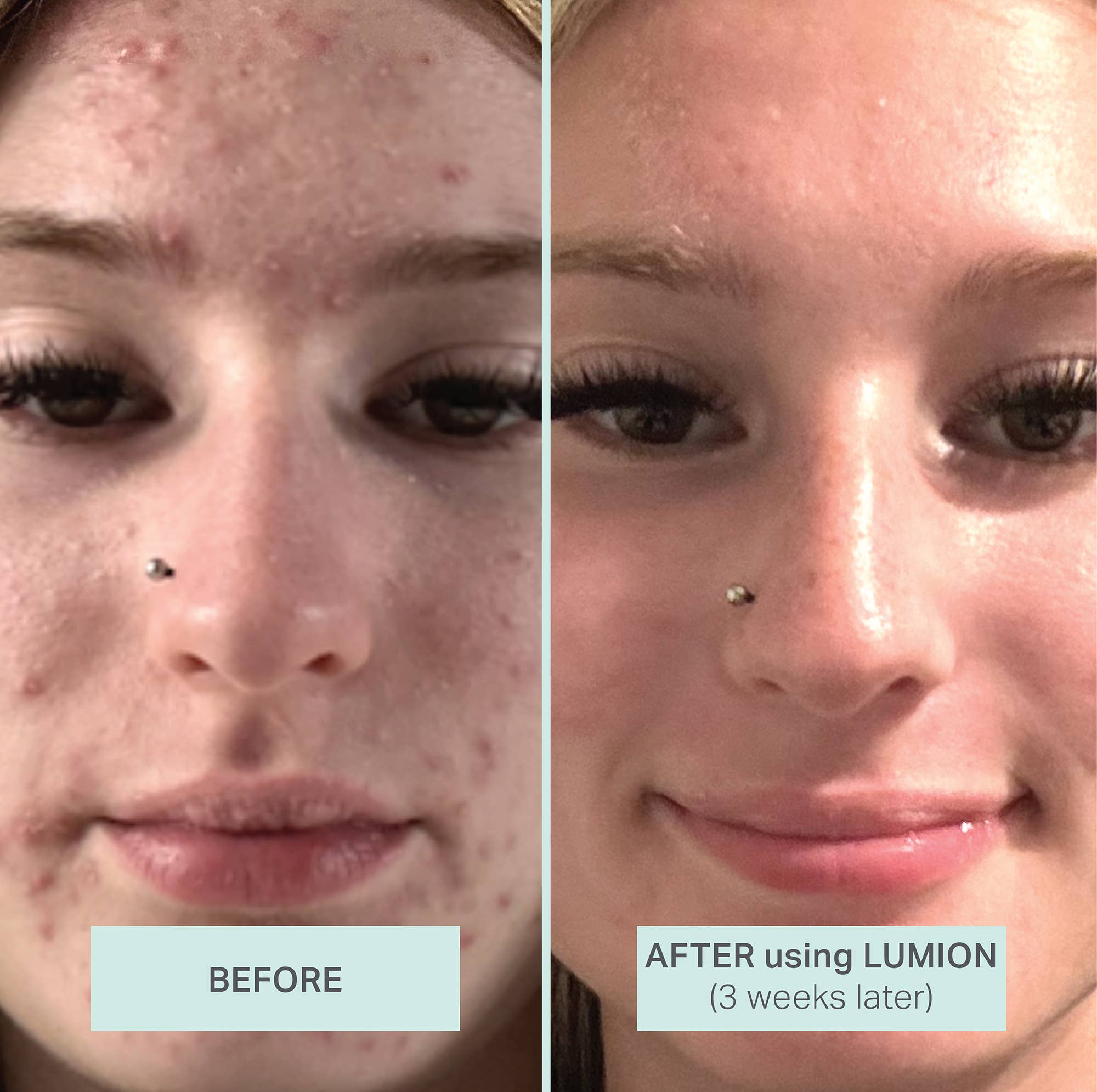 LUMION skin - Wholesale Face & Body Mist/Water - Miracle Mist with HOCL + Oxygen2