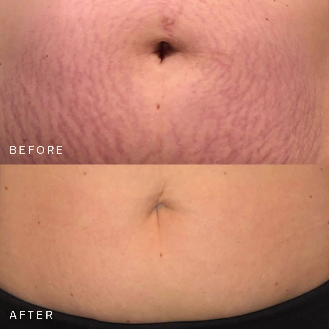 Dermaclara Beauty - Wholesale Belly Oil/Butter - Maternity - Belly & Body Occlusion Patch™ - RETAIL1