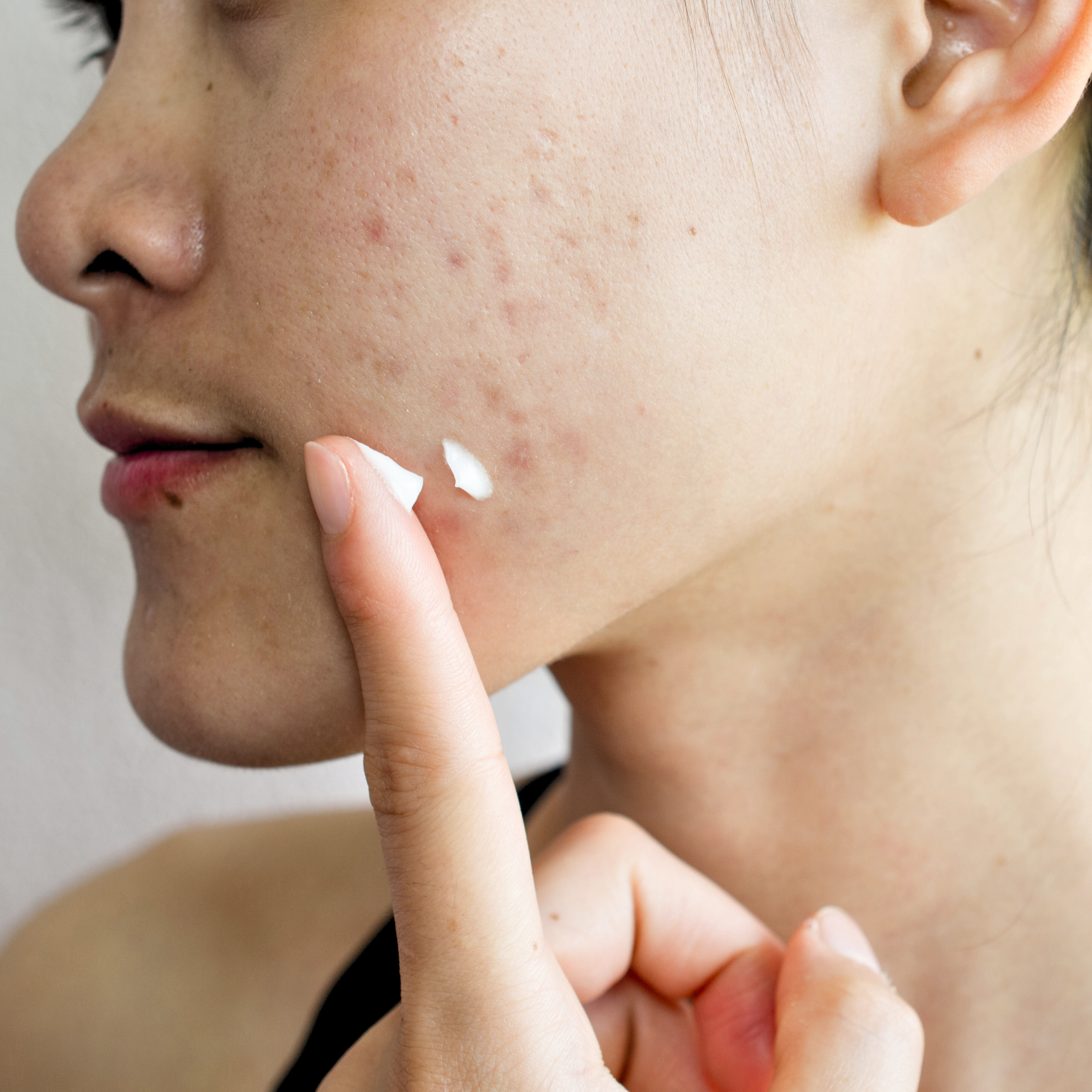 Mettalusso Inc - Wholesale Acne/Hydrocolloid Patch - Mettalusso MORIIS Modern Acne + Anti-Oxidant Hydrating Skincare Lotion4