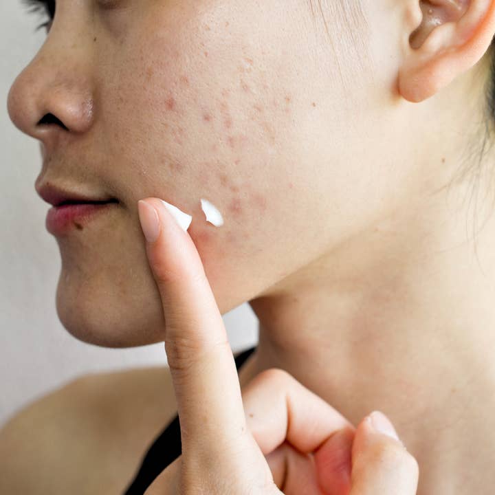 Mettalusso Inc - Wholesale Acne/Hydrocolloid Patch - Mettalusso MORIIS Modern Acne + Anti-Oxidant Hydrating Skincare Lotion4