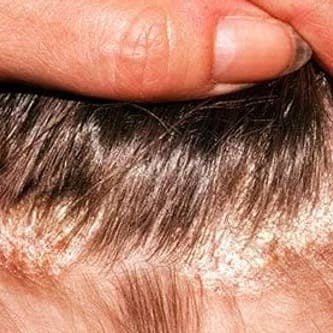 Nancy Natural Beauty Skincare - Vendita all'ingrosso Crema/lozione corpo - Sapone e crema naturali contro la tricofitosi1