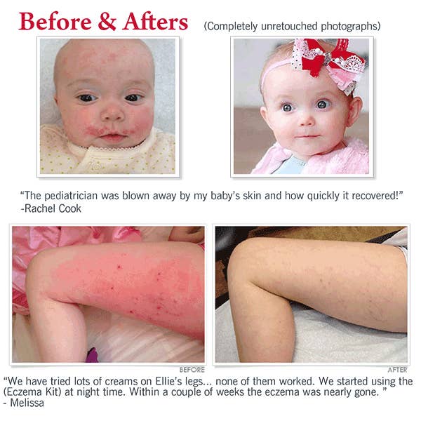 CLMD Sensitive Skincare - Wholesale Eczema Treatment - Ultimate Eczema Kit
