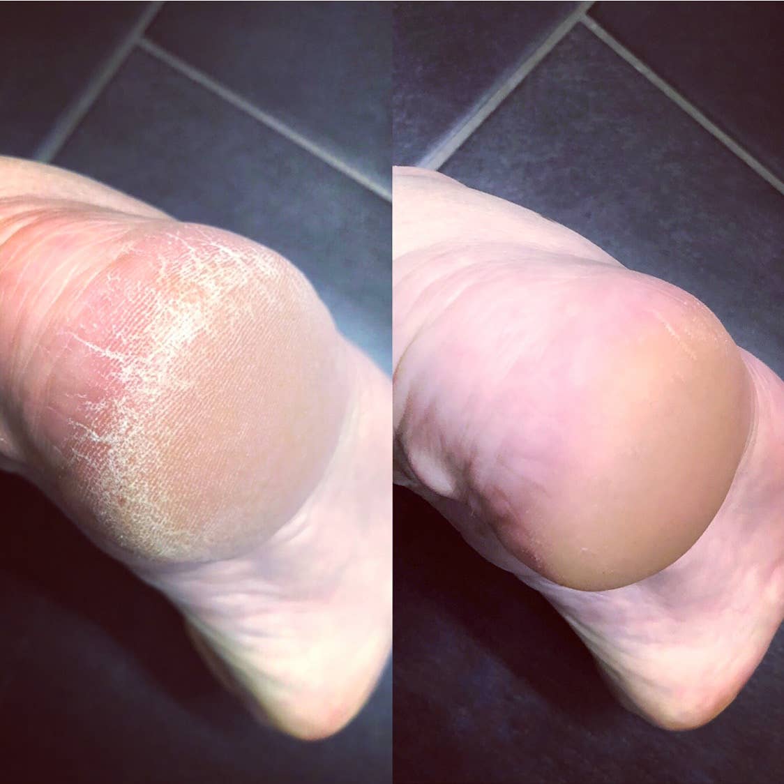 LOVASKIN - Wholesale Foot Mask - LOVASKIN Instant Foot Peel 100 ml Spray Bottle1