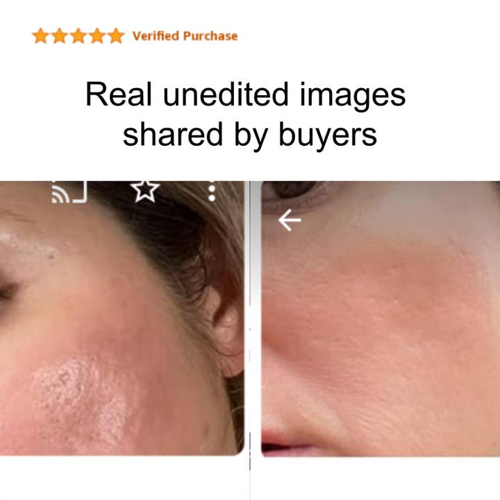 AlkaVita – Großhandel Akne-/Hydrokolloid-Pflaster – Silicon- und Kollagenpoliergel mit Kristallen gegen Aknenarben und Hautunebenheiten3