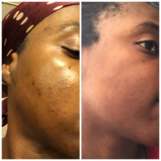 Complete Renewal LLC - Wholesale Scar Cream - Scar Butter with Turmeric and Aloe Vera- Scar Eraser Scar Cr1