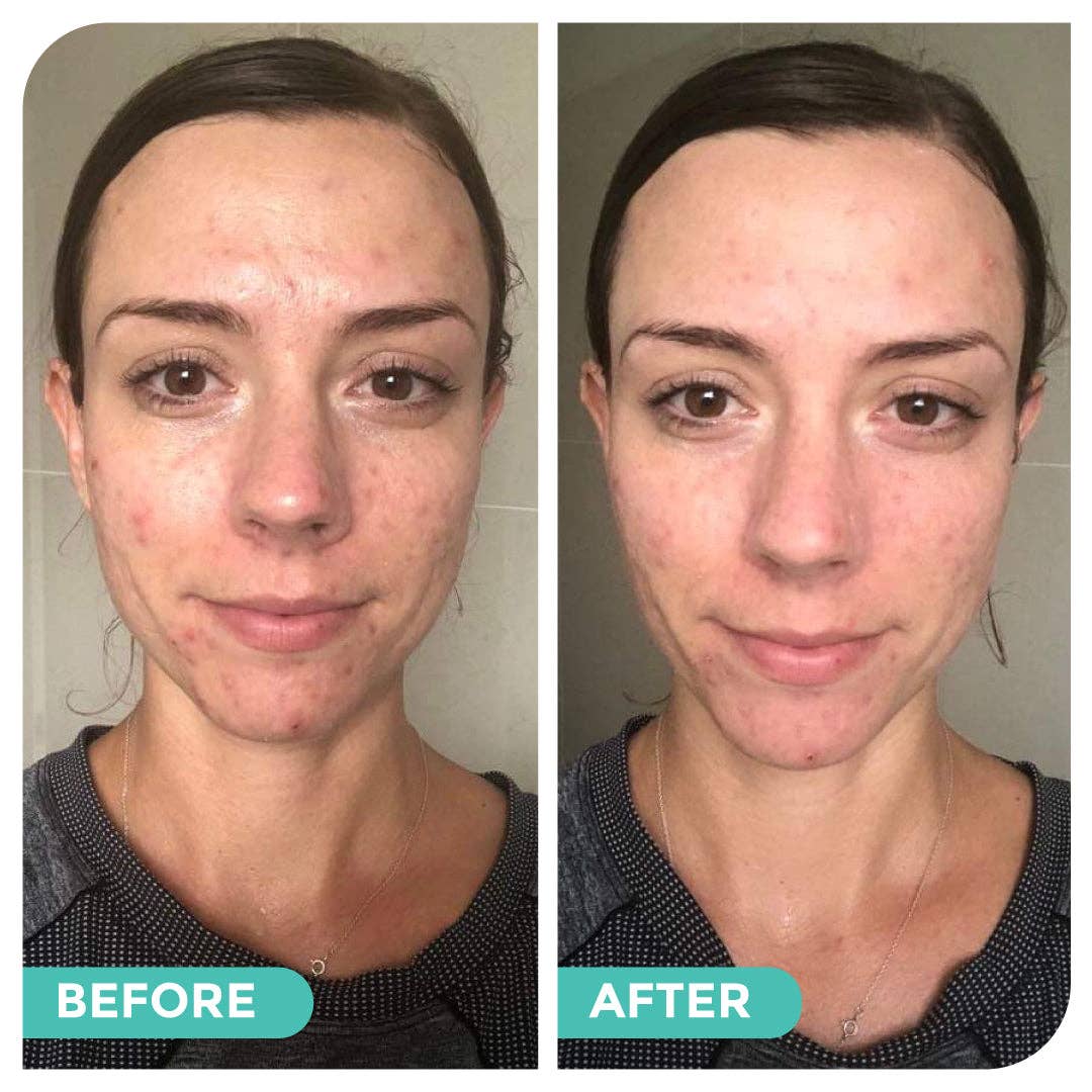 Hemp Co Australia - Wholesale Facial Care Set/Kit - Acne skincare bundle7