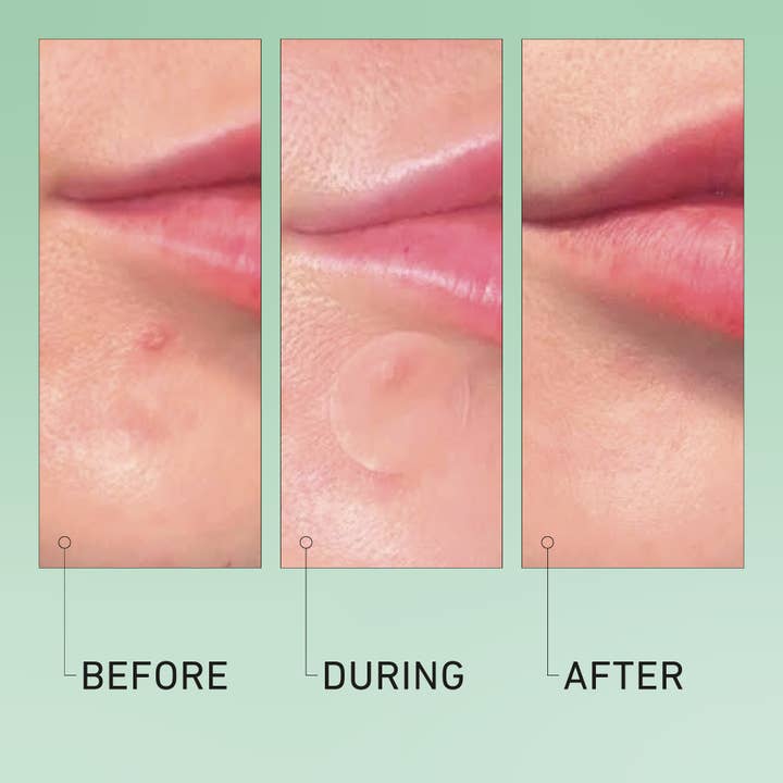 good light - Wholesale Acne/Hydrocolloid Patch - luna hydrocolloid acne pimple patch