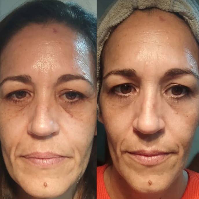 BEAUTICAL – Máscara de tratamento ocular por atacado – Patches de olho Microneedle BEAUTICAL8