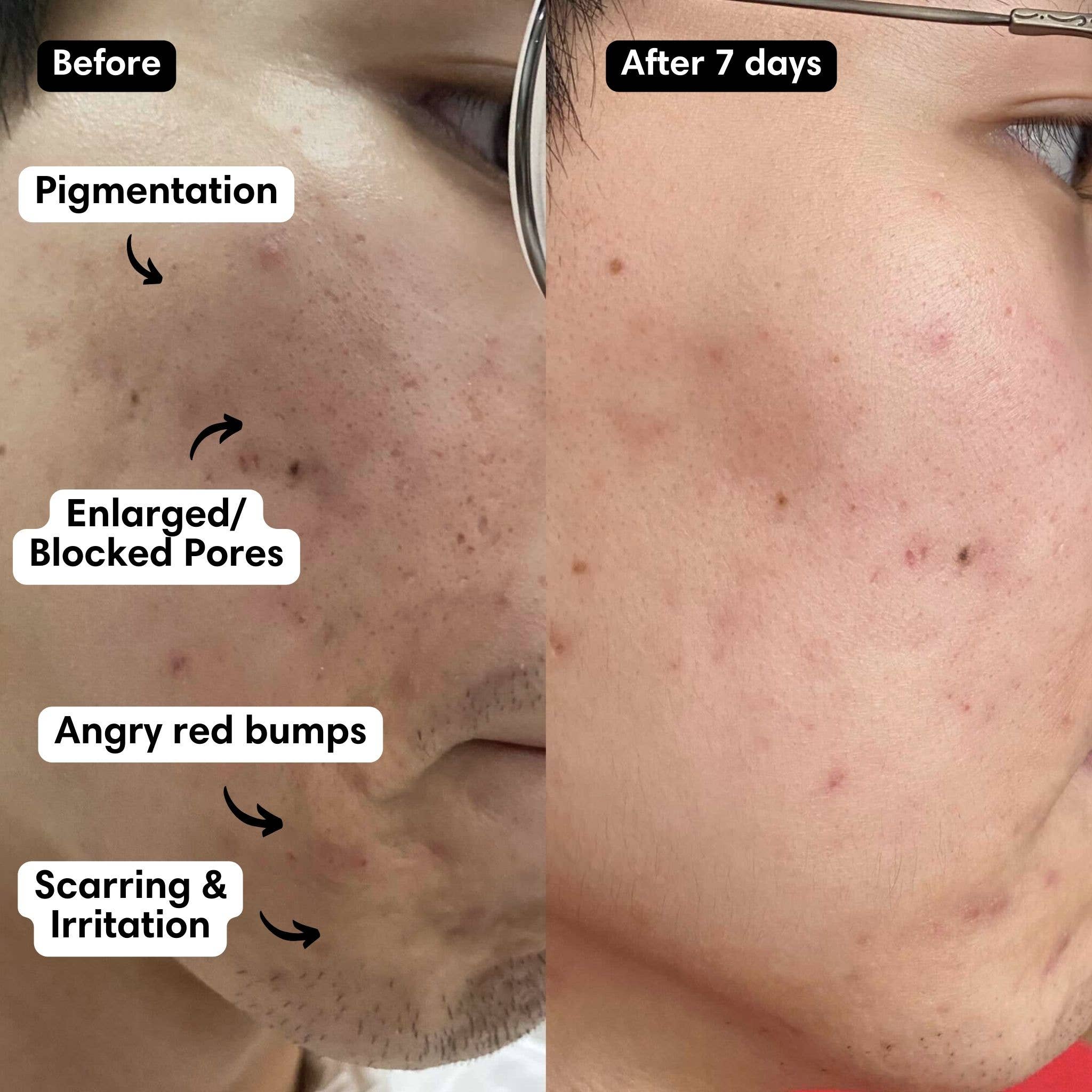 Snow Fox Skincare – Engroshandel Ansigtsmaske – Hot Stone ansigtsmaske3