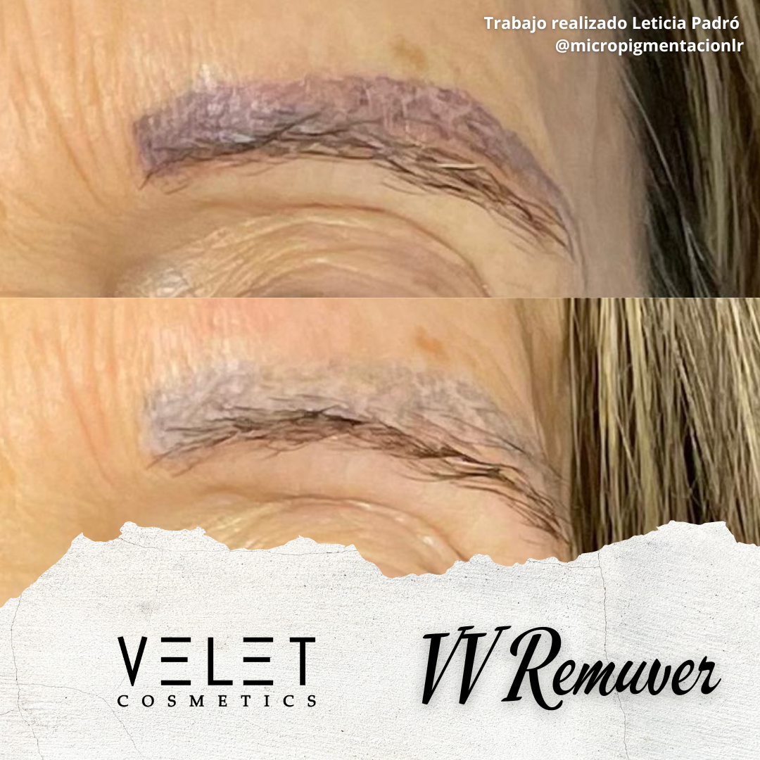 VELET COSMETICS - Wholesale Facial peel - VV Remuver | Pigment and tattoo remover5