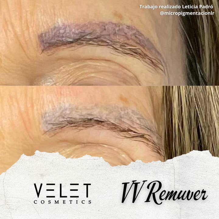 VELET COSMETICS - Wholesale Facial peel - VV Remuver | Pigment and tattoo remover5