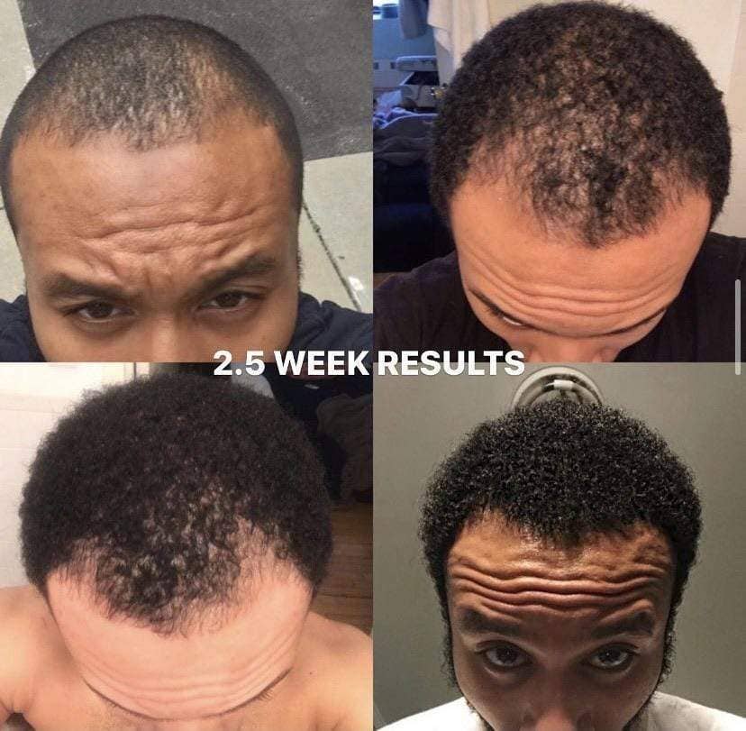 Hairresurrection - Wholesale Hair Oil - Intense Hair Growth Oil5